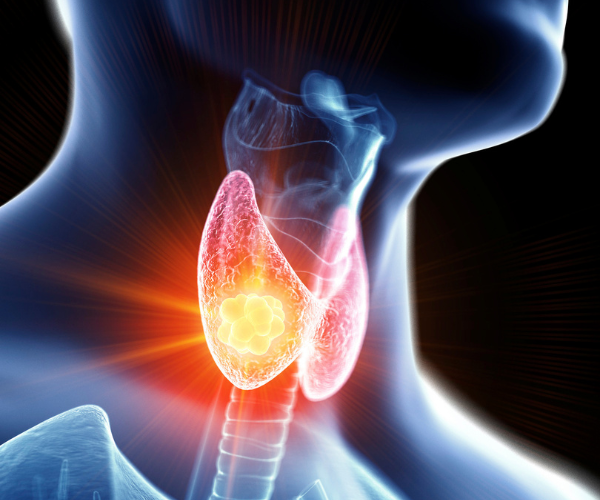 A medical illustration of a thyroid with a thyroid cancer tumor.