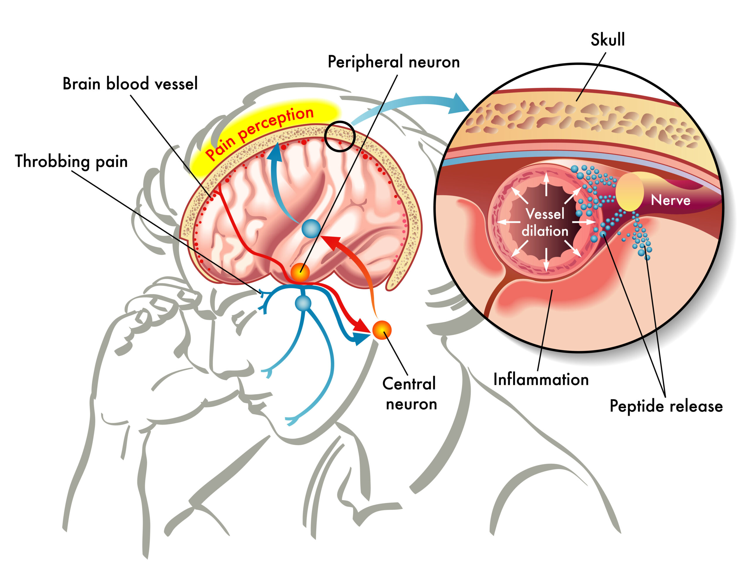 Textbook illustration showing pain caused from a headache.